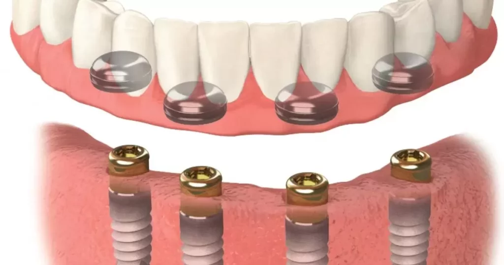  Overdentures