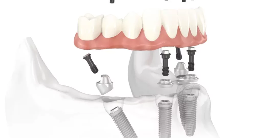 All On 4 Dental Implants