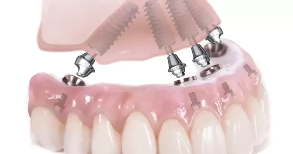 All-on-4 Implant Dentures