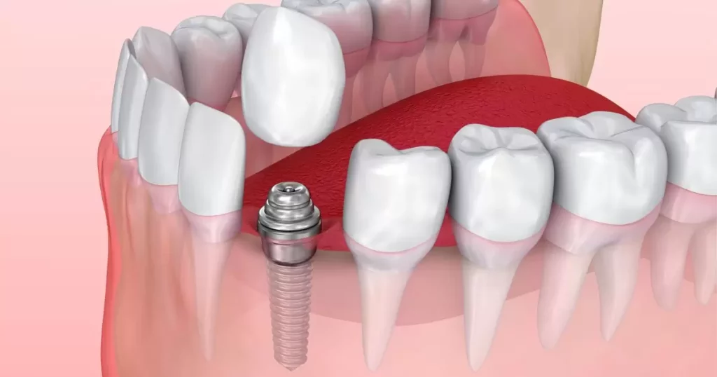 How do dental implants work?