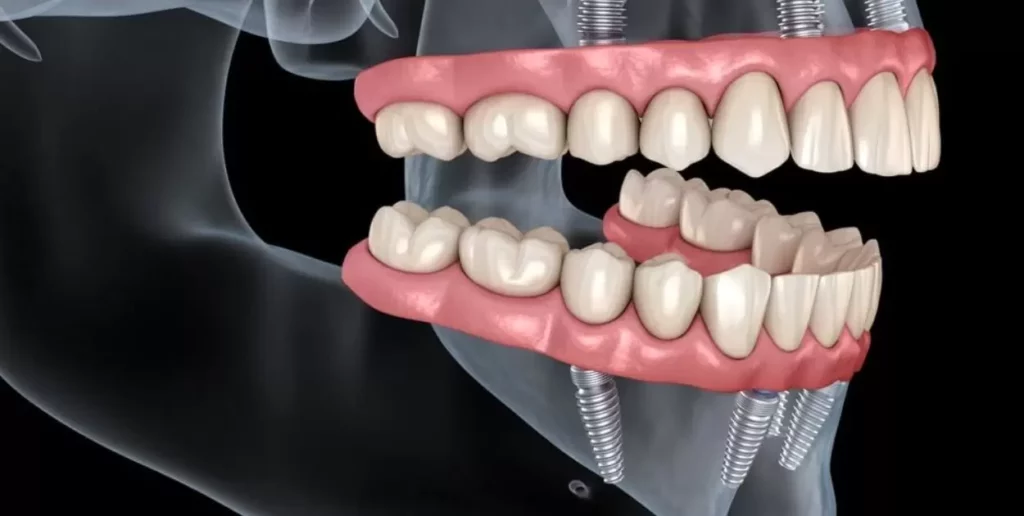 Pictures Of Hybrid Dentures