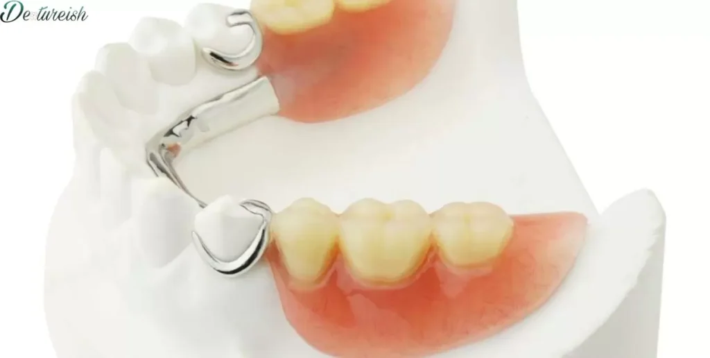 Add Clasp To Existing Partial Denture