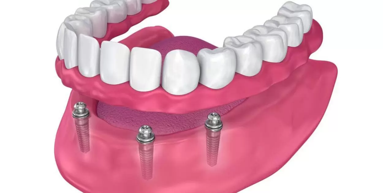 Can A Partial Denture Be Attached To An Implant?