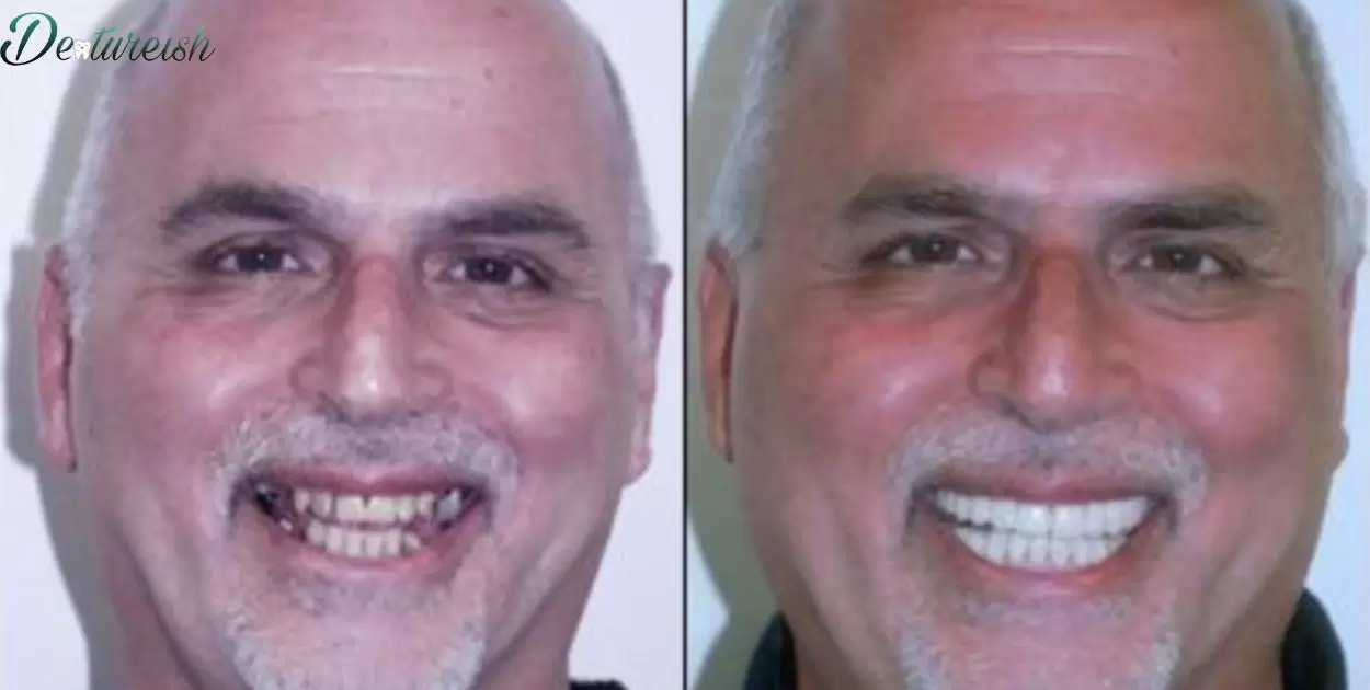 Can You Get Implants After Having Dentures?