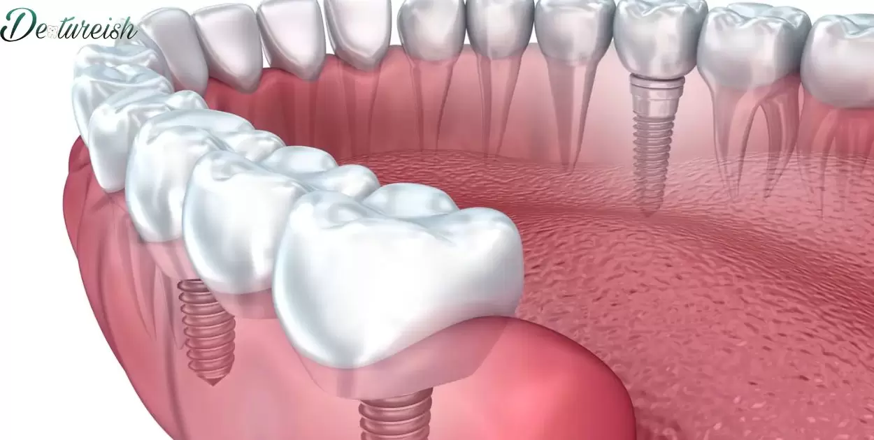 Can You Get Teeth Implants After Dentures?