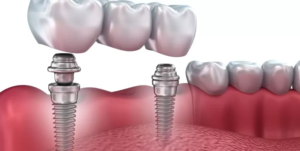 Cost Breakdown: Implant Placement