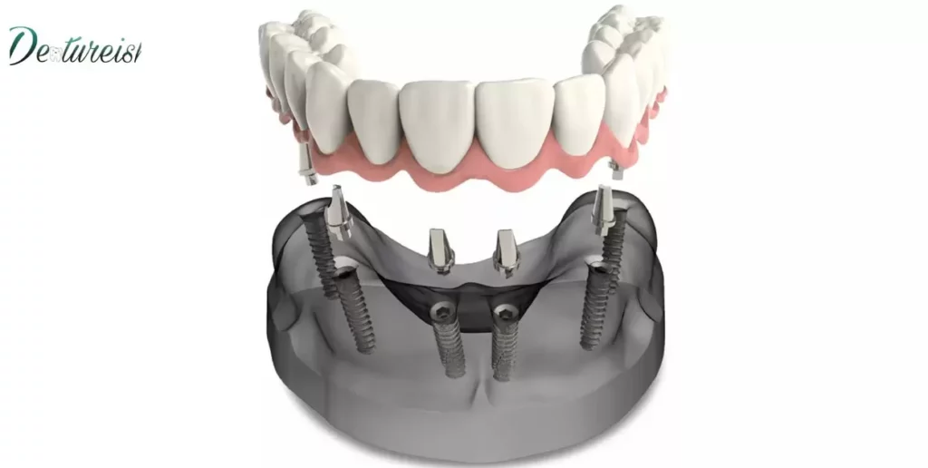 Dental Arch Implants