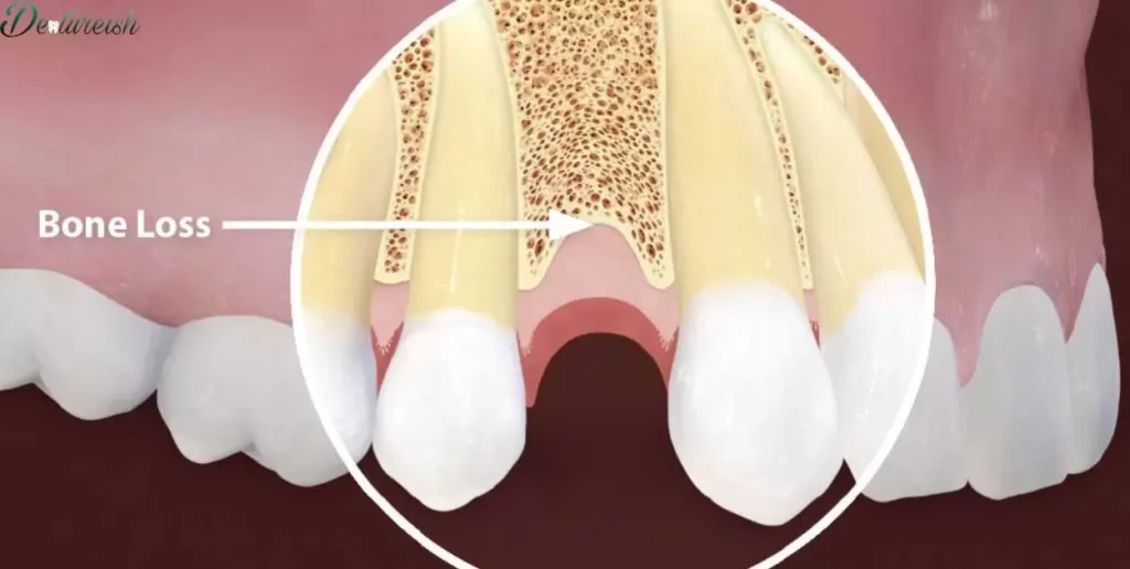 Dental Implants and Bone Density