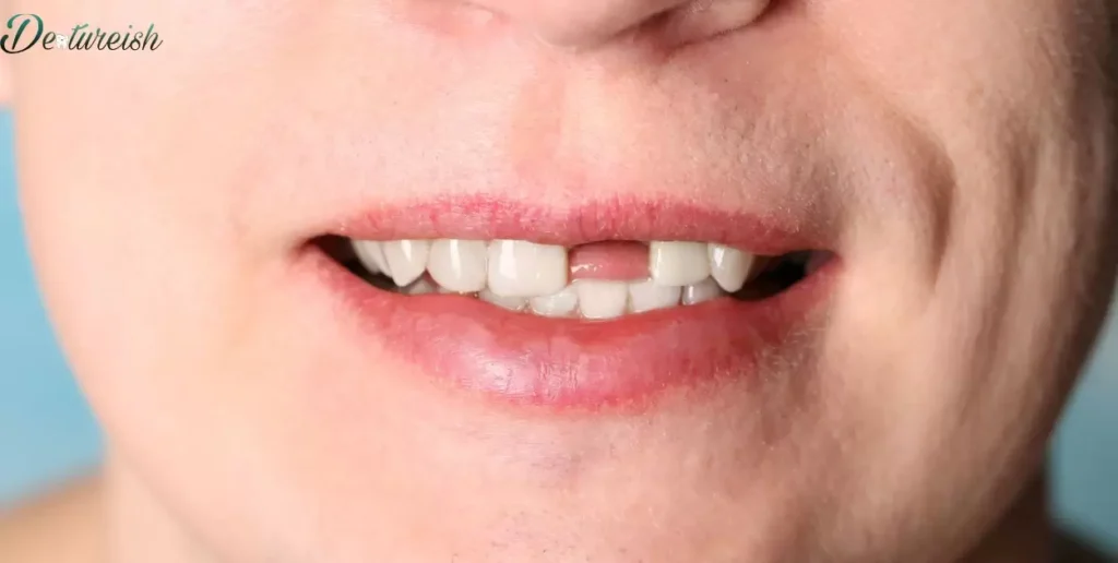 Examining the Durability of Single-Tooth Dentures