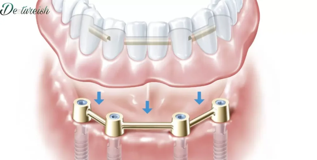 Exploring the Possibility of Implants Post-Dentures