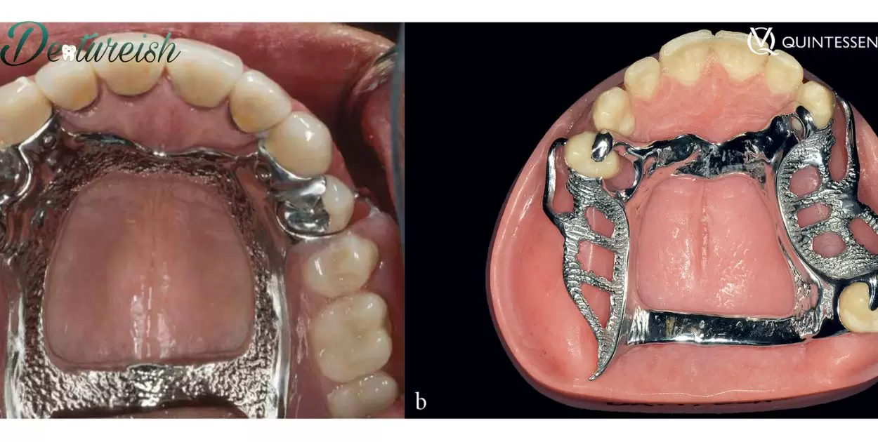 How Long Does A Partial Denture Last?