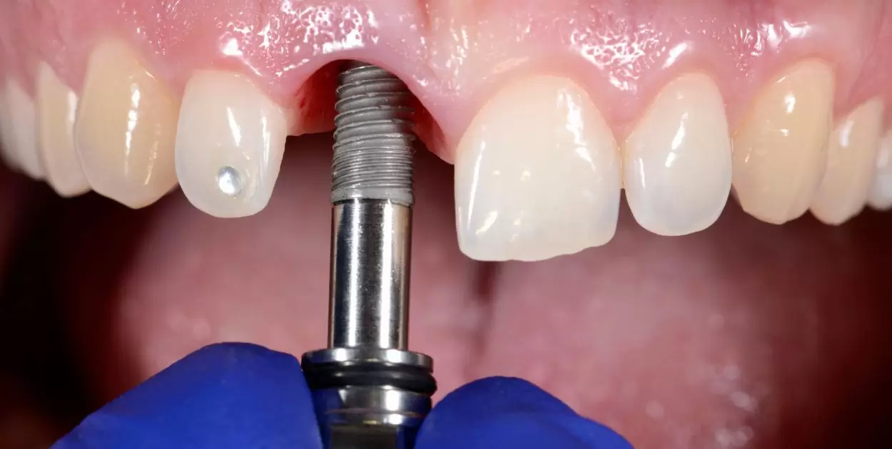 How To Clean Permanent Implant Dentures?