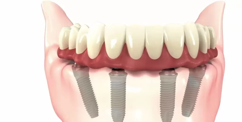 Insurance Coverage for Implant Dentures