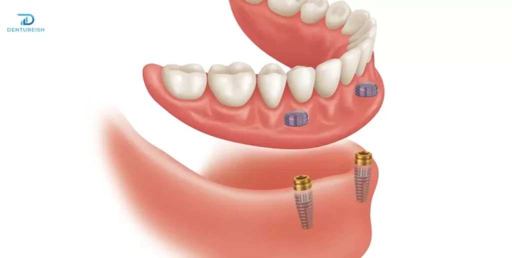 Materials Used in Denture Arch Construction