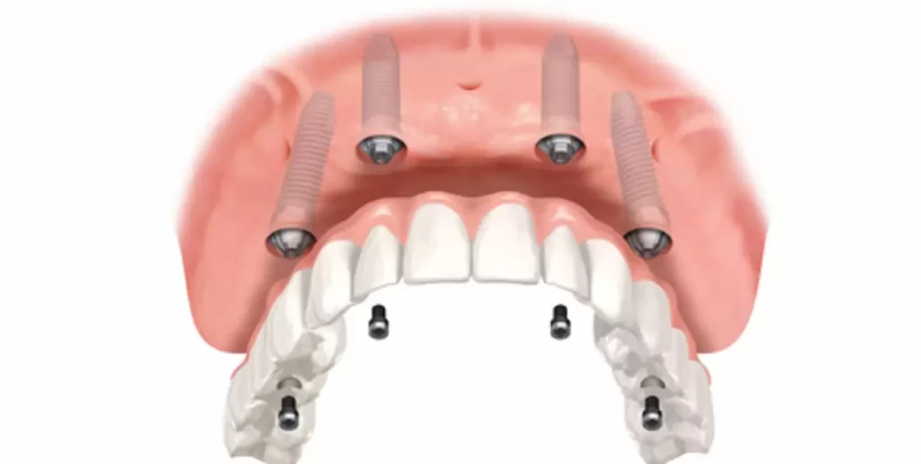 Patient Experiences with Per Arch Denture Solutions