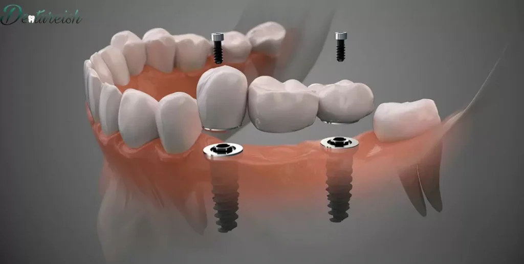 Understanding the Concept of Dental Implants