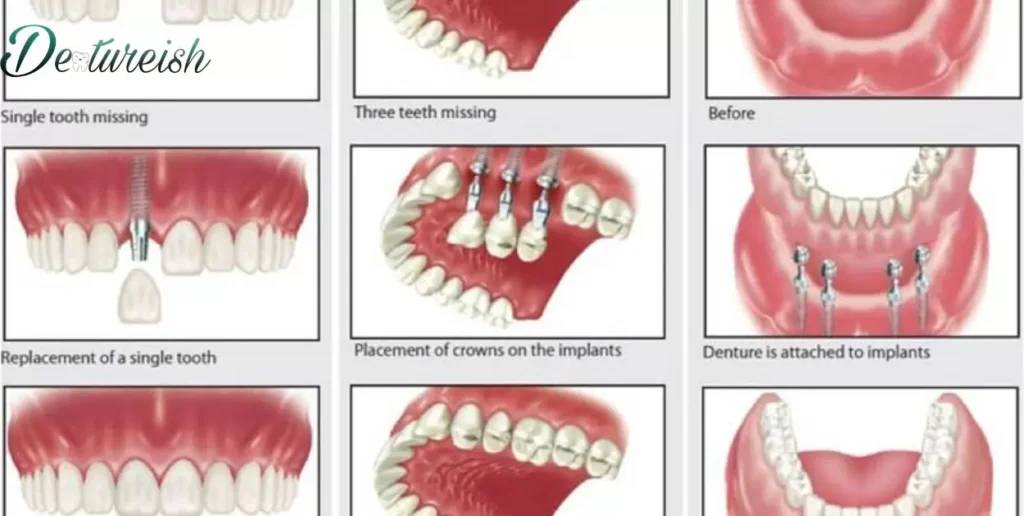 What Does A Single Tooth Denture Look Like