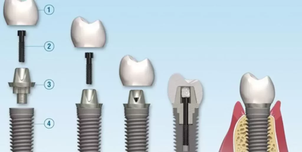 What Does It Mean That The Cost For Dental Implants Is Per Arch?