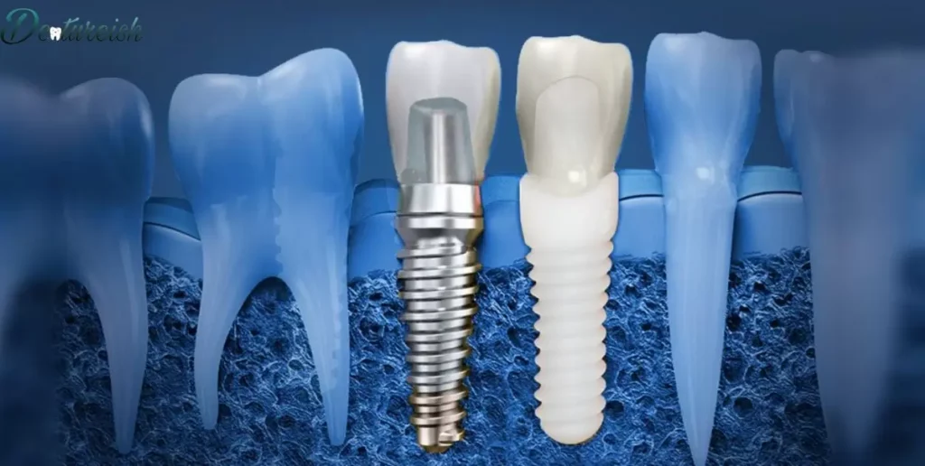 When Is It Too Late To Get Dental Implants