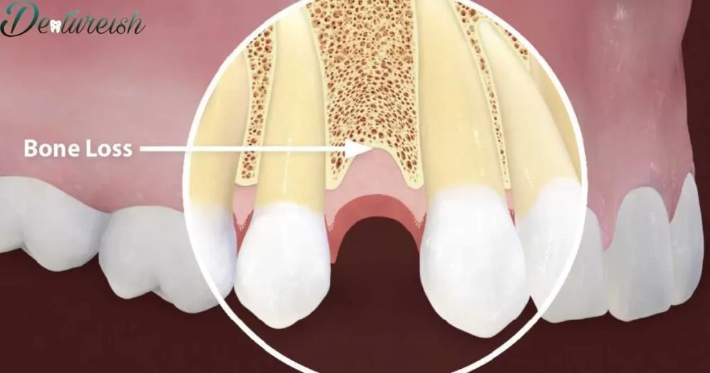 Can leaving in a partial denture lead to bone loss in my jaw?