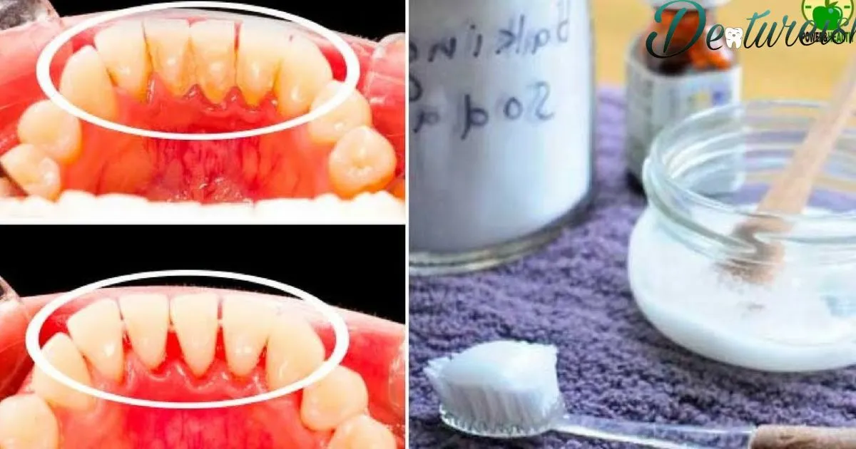 How To Remove Plaque And Tartar From Dentures