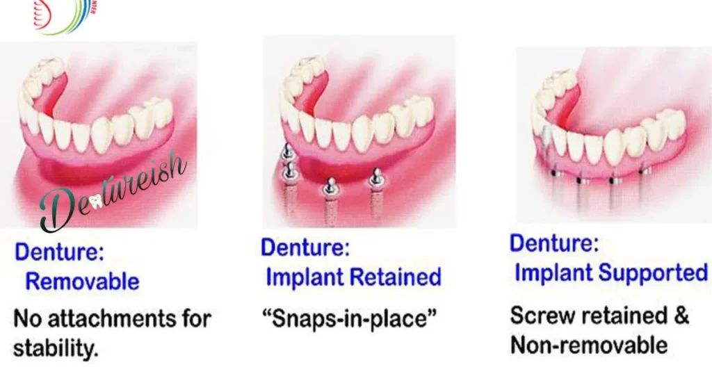 Should I get a night guard denture or retainer denture?