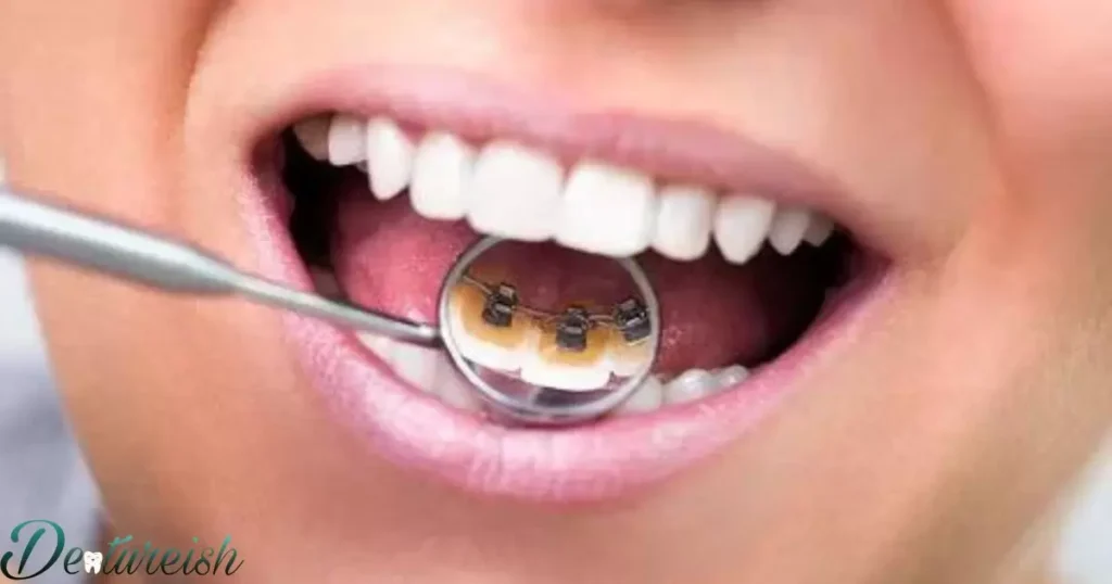 Braces Key: Alternatives For Nutrition