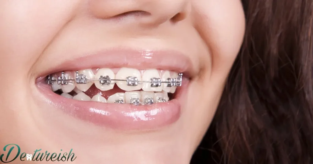 Braces Key Procedure: How Is It Performed?