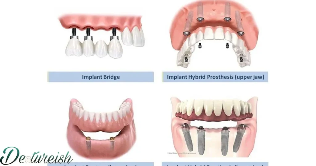 Different Types Of Dental Implants And Dentures