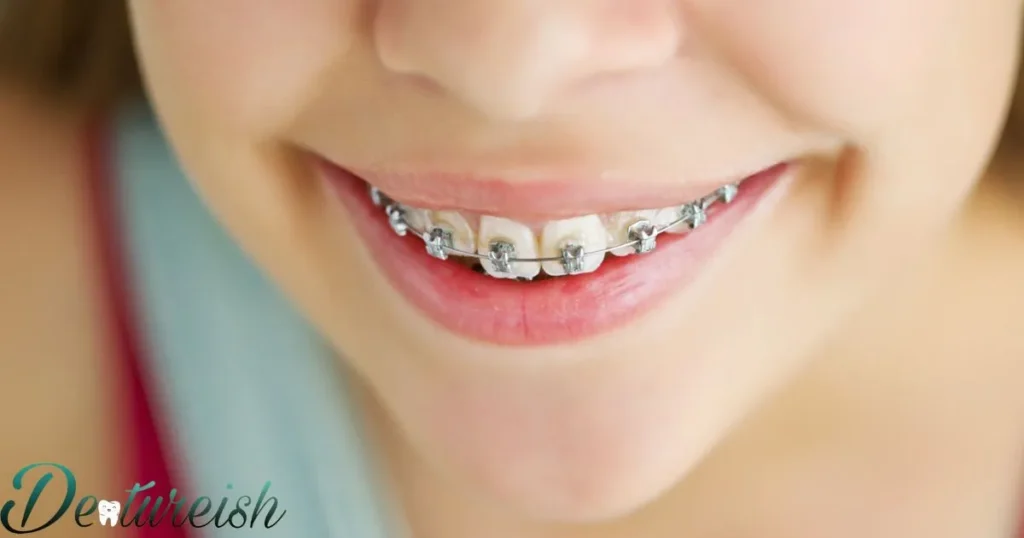 Do Braces Prices Vary By Region In Michigan?