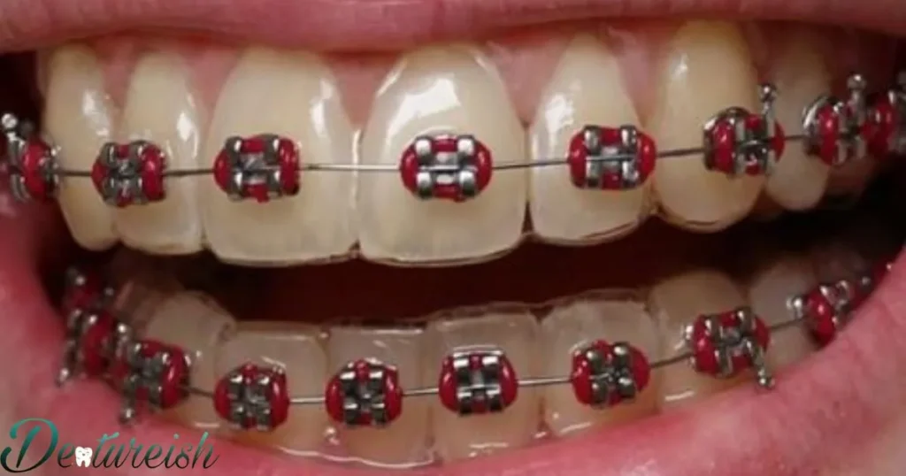 Exploring The Impact Of Red Braces