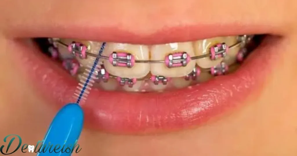 Step-By-Step Process For Reinserting Braces Key Wire