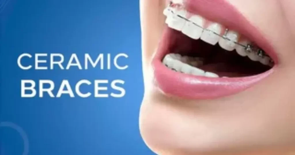 Are Ceramic Braces A Good Alternative?