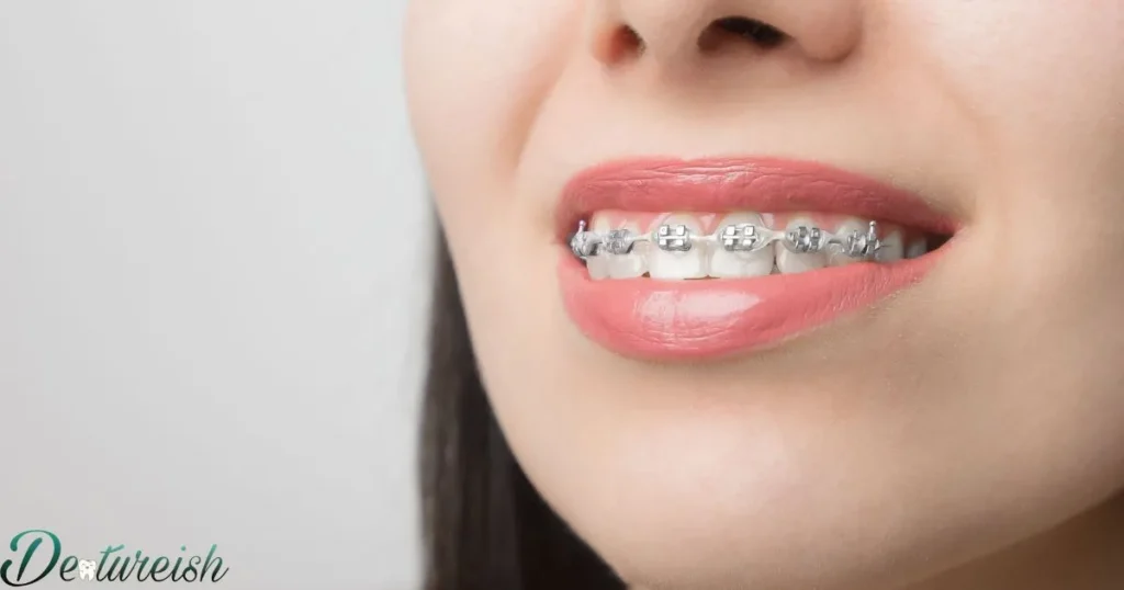 Are Clear Aligners A Good Alternative To Metal Braces?