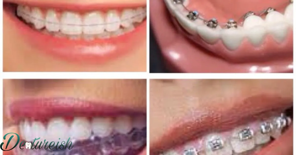 Different Type Of Braces Brackets