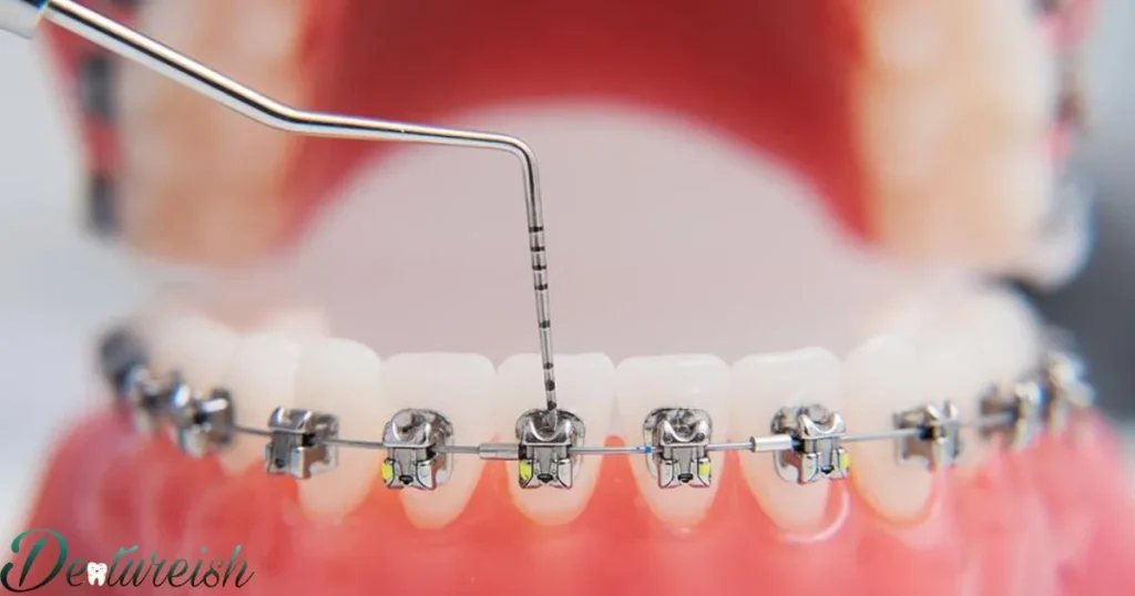 How Do Metal Braces Work?