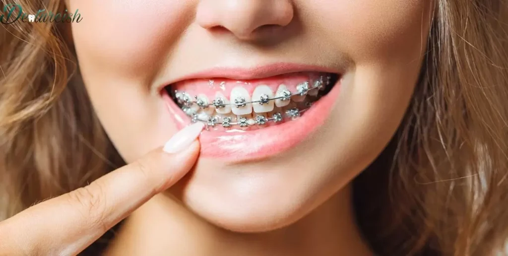 Is The Ceramic Braces Lawyer Needed?