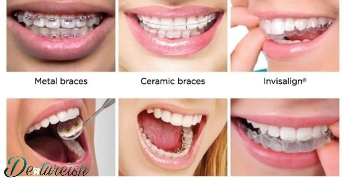 Lingual Braces Vs Normal Braces