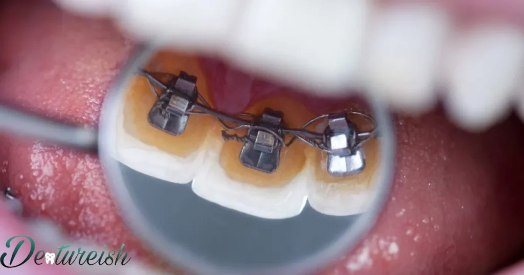 What Are Lingual Braces?